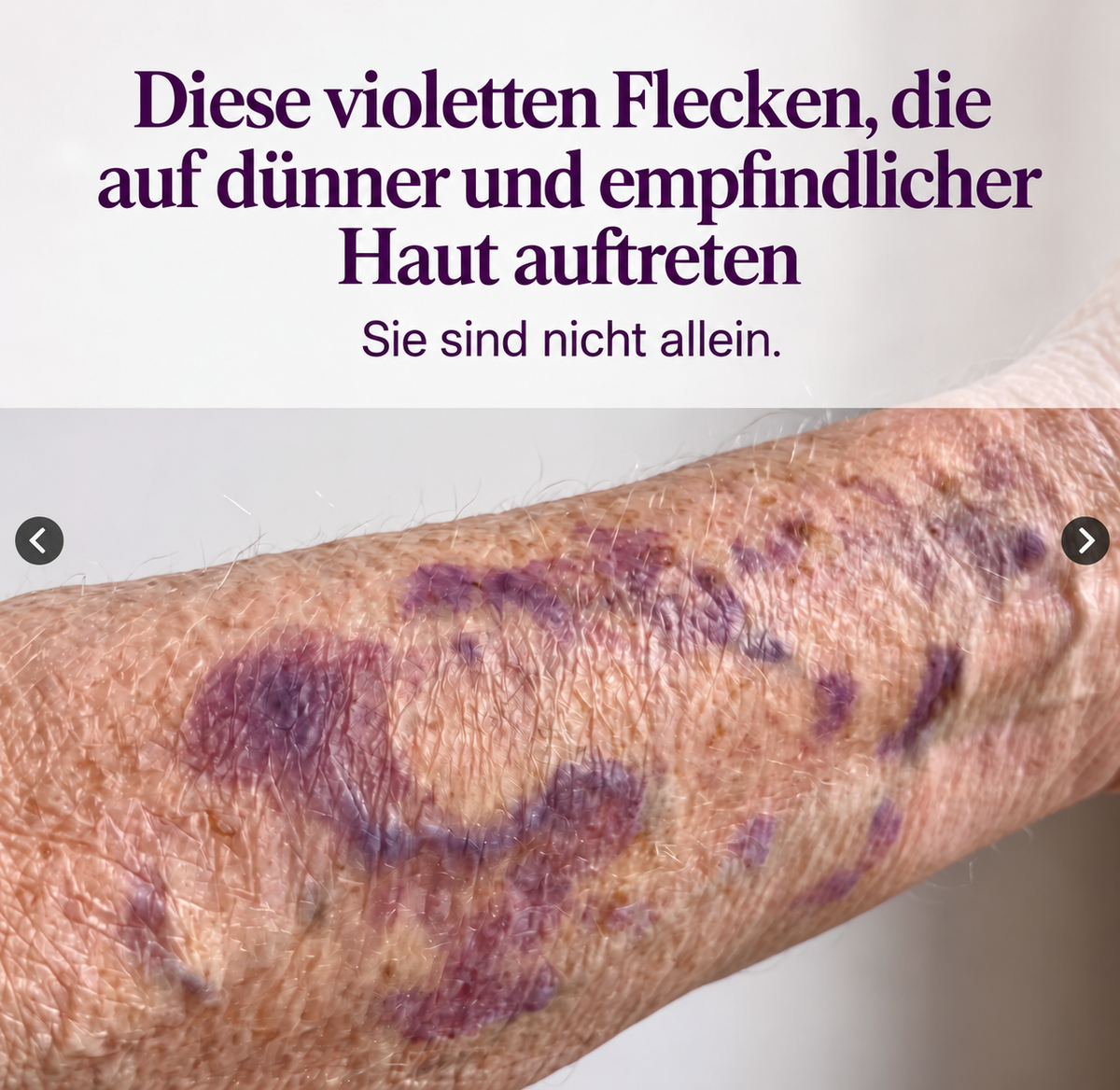 ZARTDERM® Spray gegen blaue Flecken – für empfindliche, dünne Haut