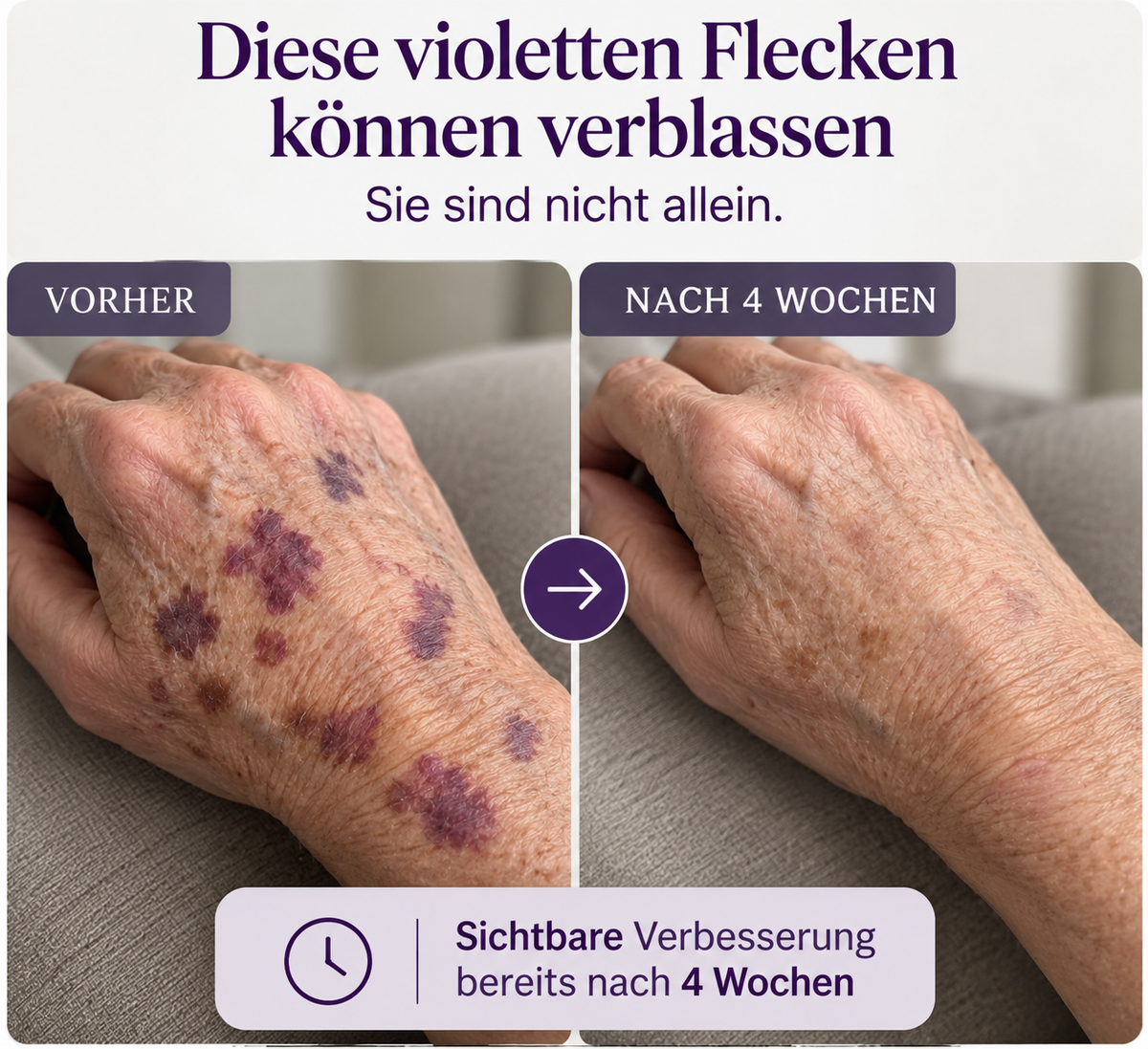 ZARTDERM® Spray gegen blaue Flecken – für empfindliche, dünne Haut