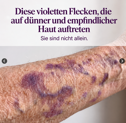 ZARTDERM® Spray gegen blaue Flecken – für empfindliche, dünne Haut